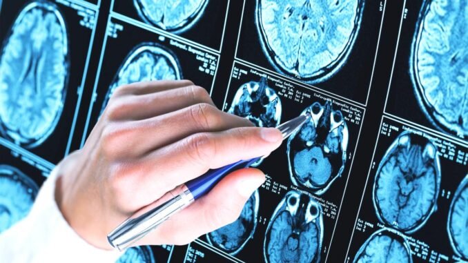 yeni-alzheimer-tedavisi-uzerine-umut-veren-gelismeler-Kc2L4pAA.jpg